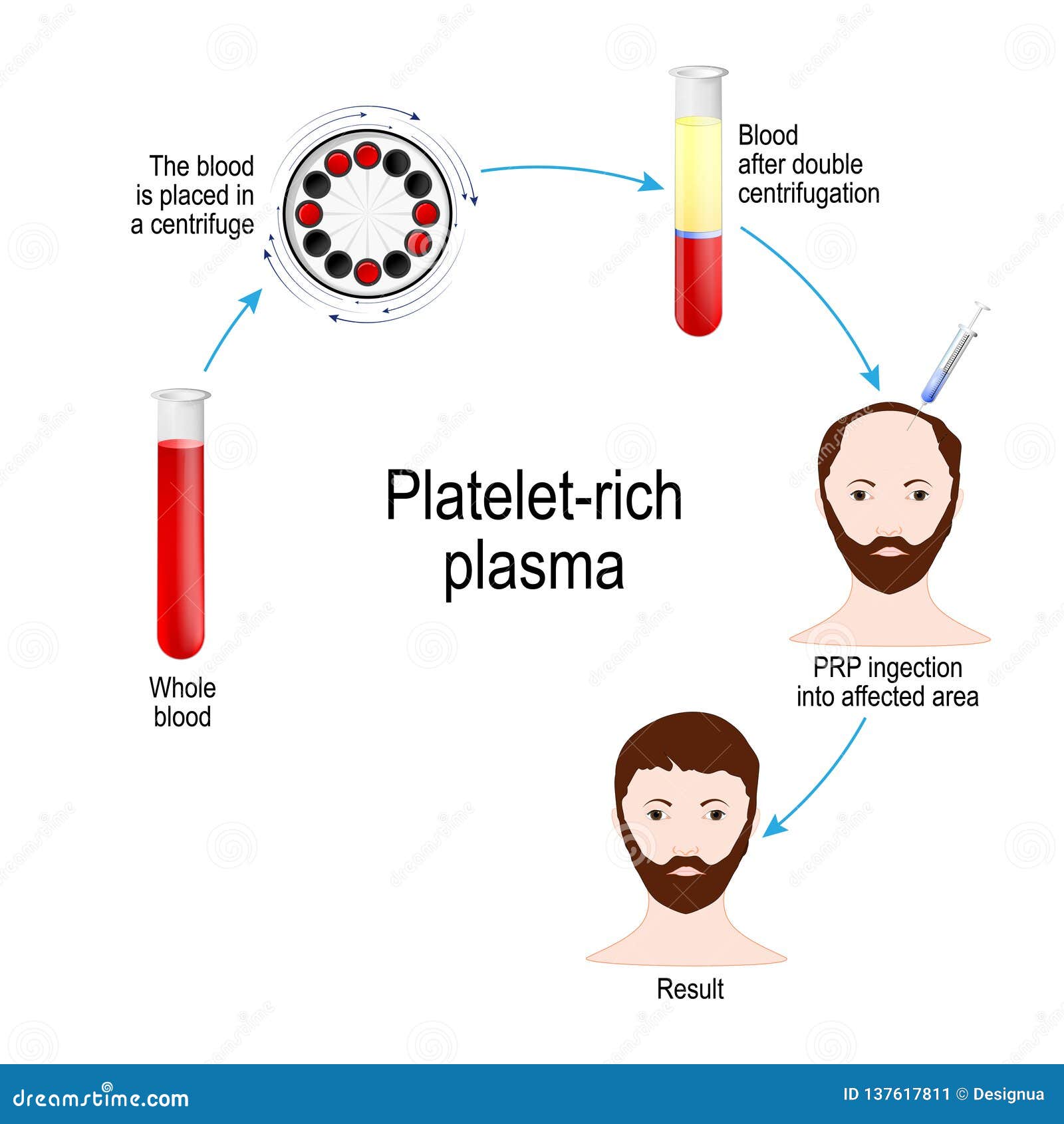platelet-rich plasma. prp hair therapy. medical procedure